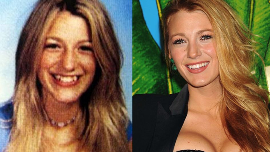 Blake Lively et la chirurgie esthétique