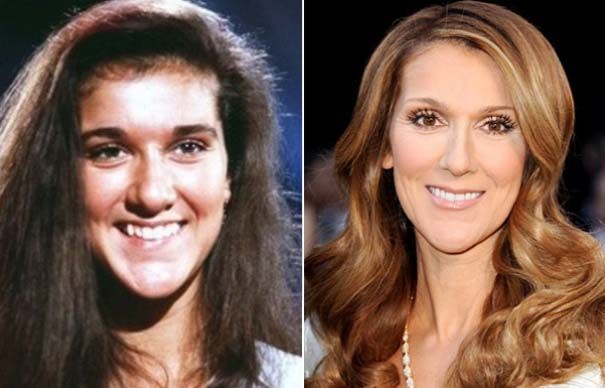 Céline Dion et chirurgie esthétique