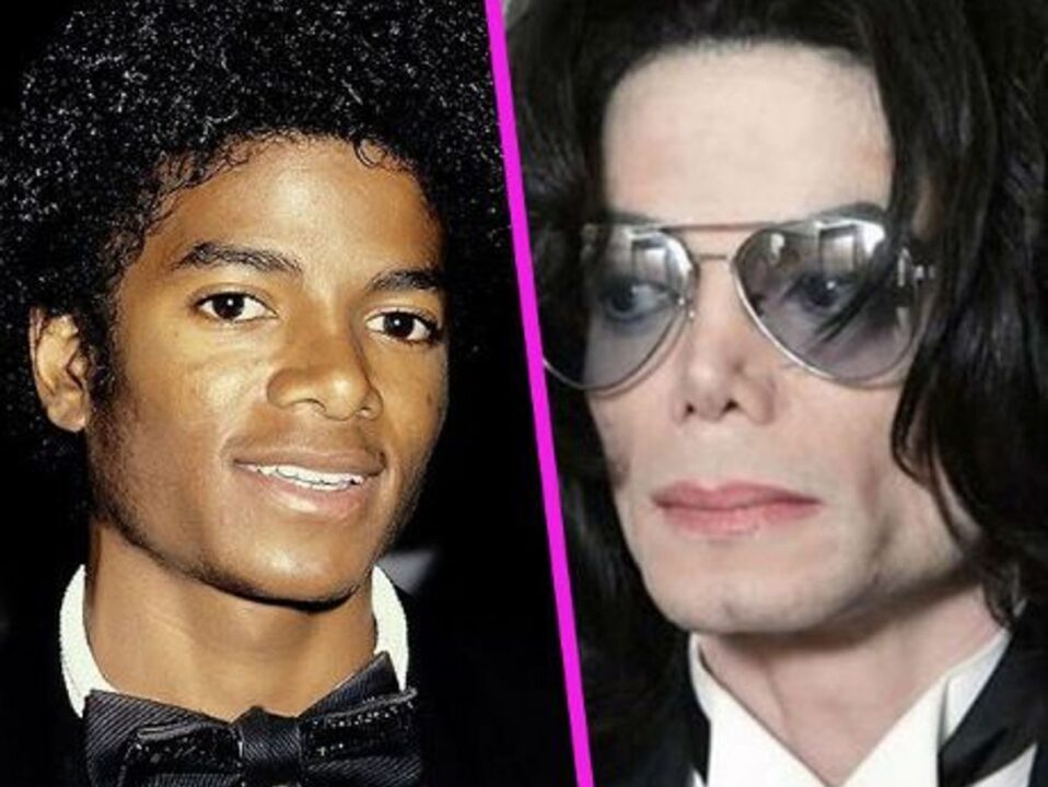 Michael-Jackson accro chirurgie esthétique