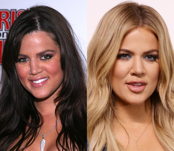 Khloé Kardashian et chirurgie esthétique