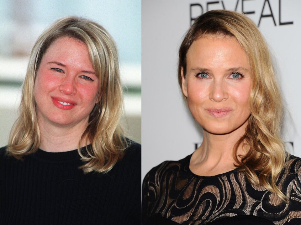 Renée Zellweger et la chirurgie esthétique